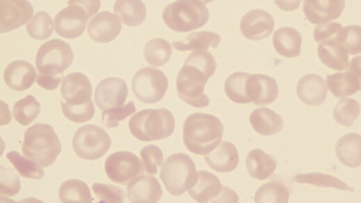 New York Blood Center Enterprises Researchers Identify New Immune Response Mechanisms in Sickle Cell Disease