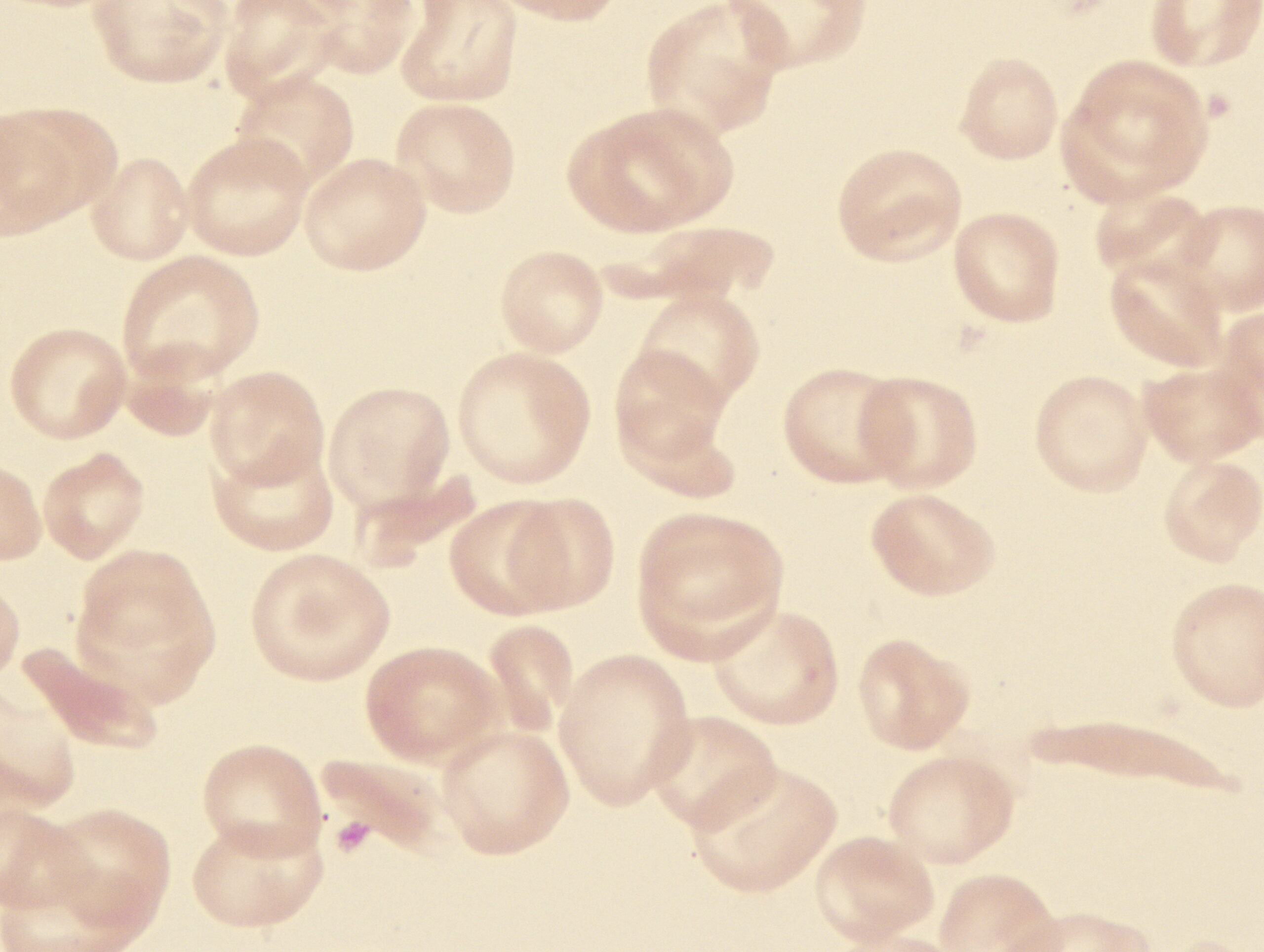 Sickle Cell